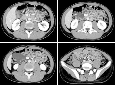 Case report: A mesocolic lymphangioma in a 14-year-old child resected by laparoscopic surgery